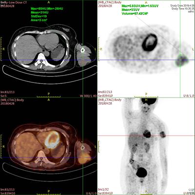 Case report: Malignant epithelioid angiosarcoma in a Chinese female patient